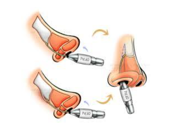 Imagem de uma rinoplastia